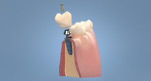 $800 dental implants dr dowlatshahi