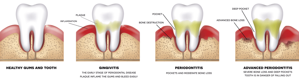 full mouth dental implants dr dowlatshahi
