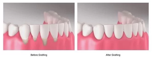 permanent dentures dr dowlatshahi