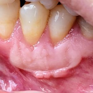 permanent dentures cost 2020 dr dowlatshahi