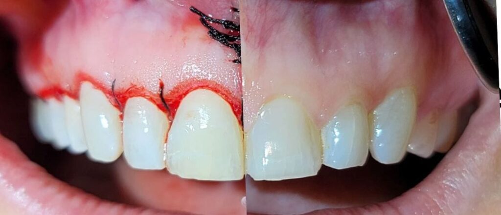 single tooth implant cost dr dowlatshahi