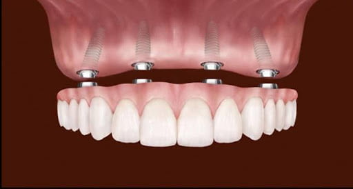 cheap dental implants dr dowlatshahi