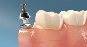cheapest dental implants near me dr dowlatshahi