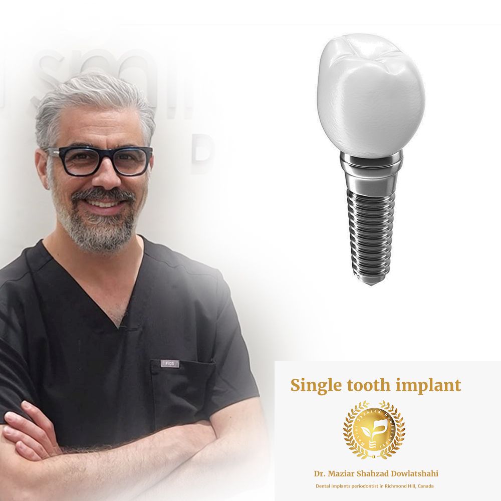 bond street dental implants toronto dr dowlatshahi