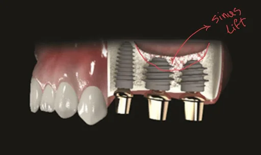 denture implants dr dowlatshahi
