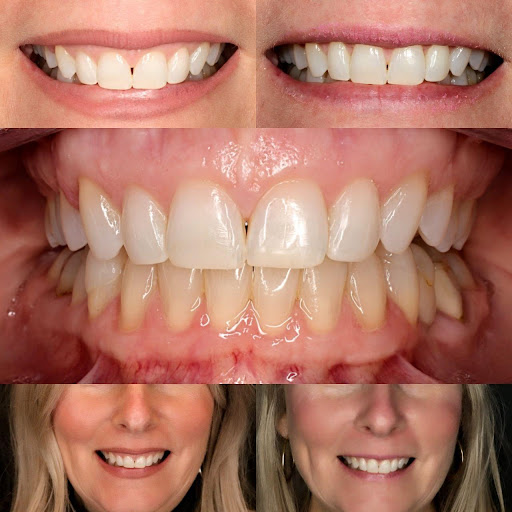 before and after pictures of a patient with a gummy smile, treated with cosmetic crown lengthening surgery by Dr.Dowlatshahi.
